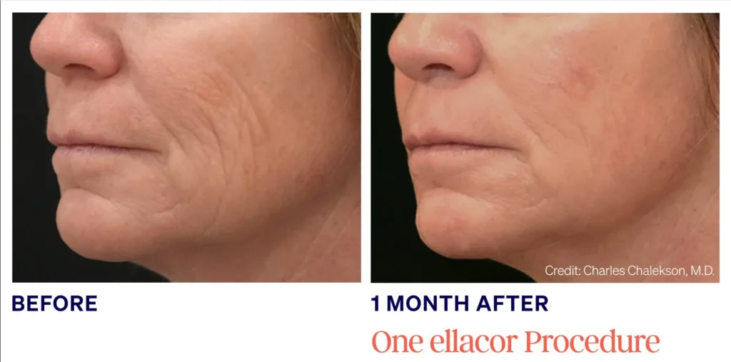 Before and 1 month after ellacor